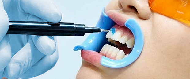 Authentic whitening gel