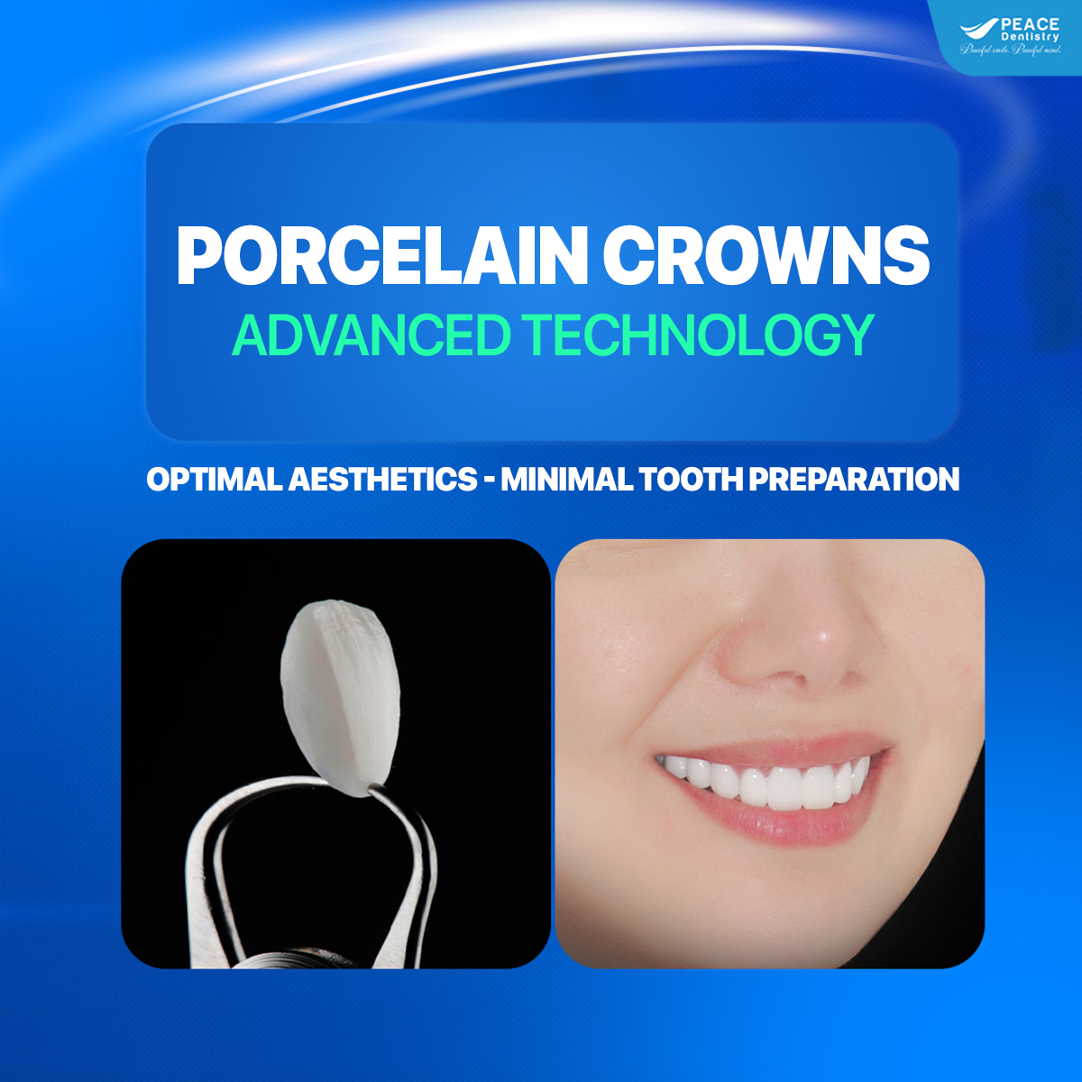 banner dental crowns