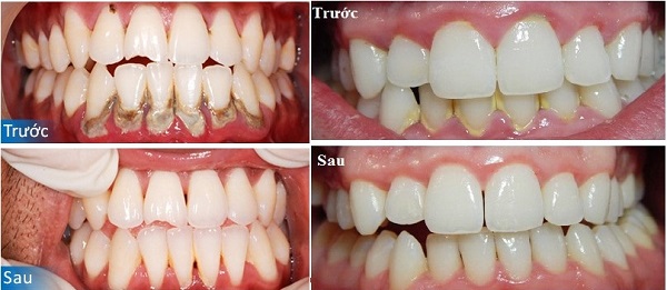 vôi răng gây ra bệnh nha chu