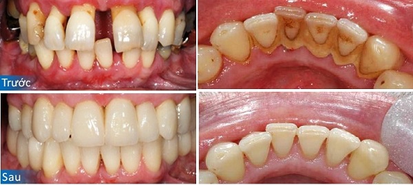 bệnh nha chu gây mất răng