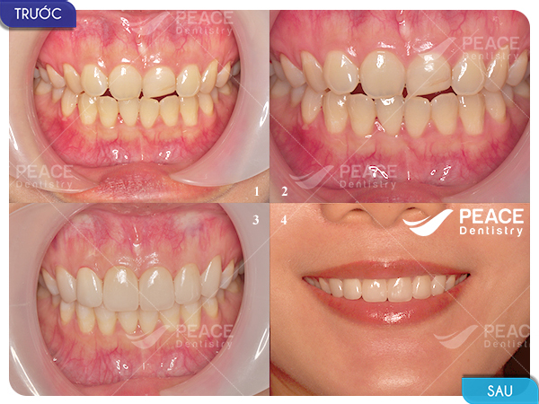 Bọc 10 răng sứ Zirconia hàm trên thẩm mỹ nụ cười