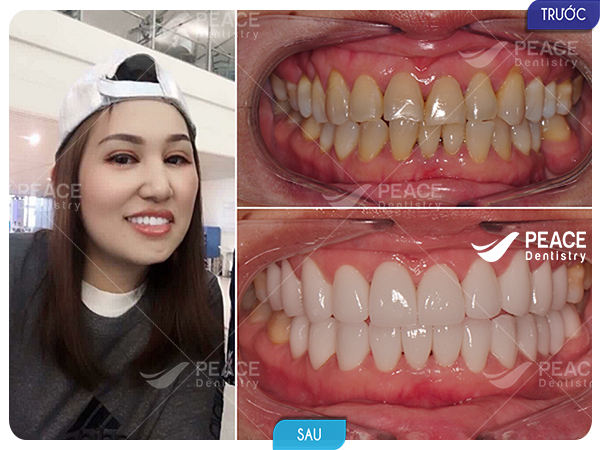 Bọc 20 răng sứ Zirconia cho răng nhiễm kháng sinh, hình thể xấu, sâu răng