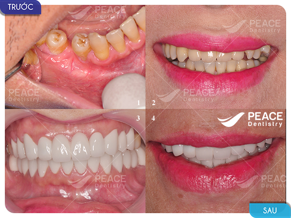 Bọc 20 răng sứ zirconia nguyên hàm cho răng hình thể xấu, tối màu