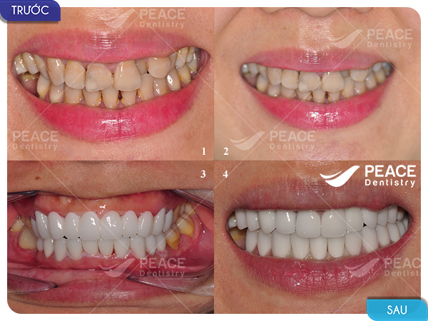 Bọc 20 răng sứ Zirconia Zolid cho răng tối màu, hình thể không đẹp