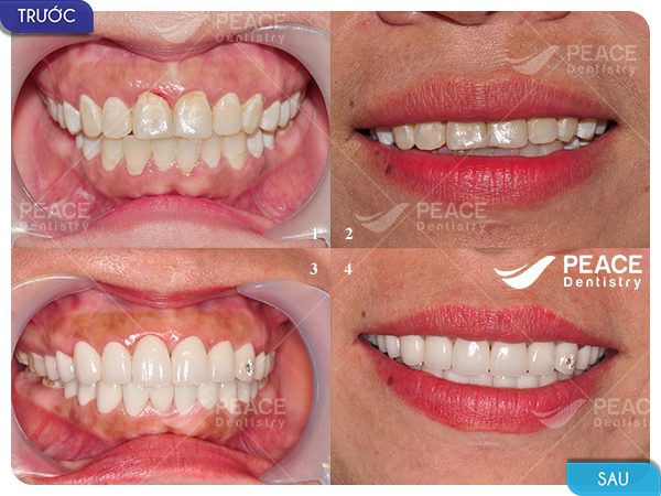 Bọc 22 răng sứ Zirconia Zolid - thẩm mỹ toàn diện nụ cười