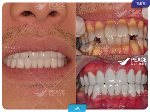 Bọc răng sứ Zirconia nguyên hàm (20 răng) thẩm mỹ toàn diện nụ cười