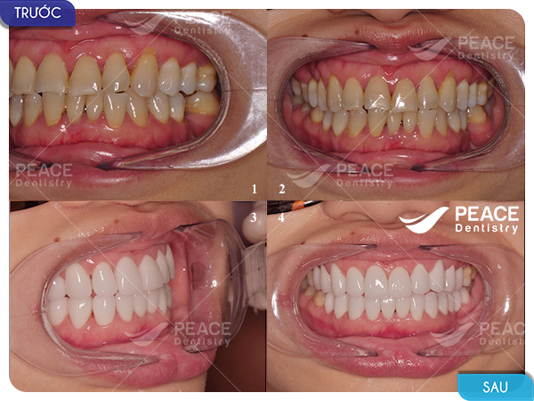 Bọc răng sứ nguyên hàm cho răng nhiễm kháng sinh, thưa răng cửa