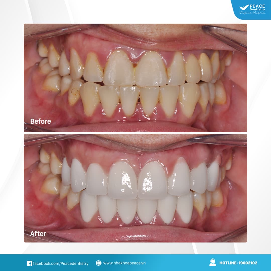 dán sứ veneer cho răng hình thể xấu