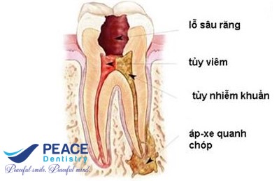 răng sâu dẫn đến viêm tủy