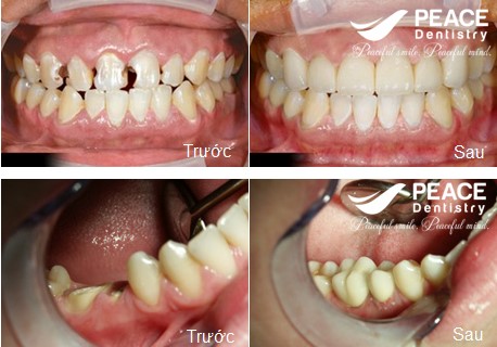 bọc răng sứ cho răng sâu