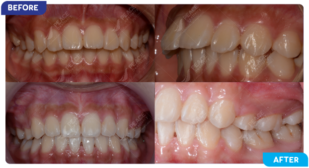 image of a patient undergoing orthodontic treatment 1