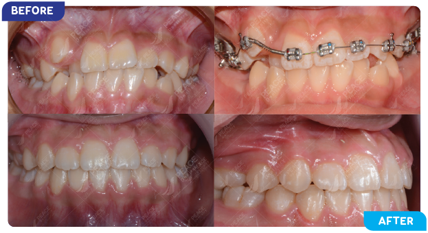 image of a patient undergoing orthodontic treatment 5