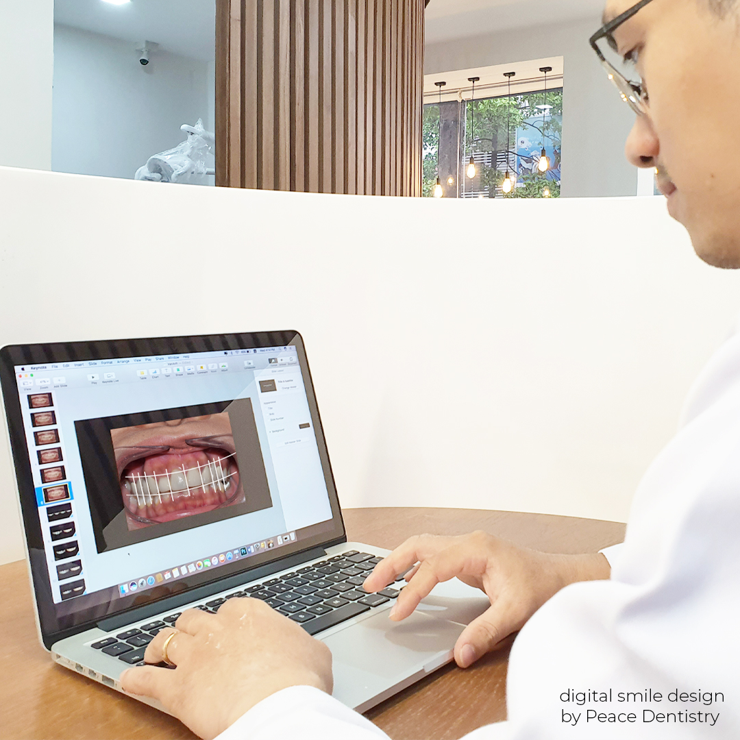 quy trình dán sứ veneer tại peace dentistry