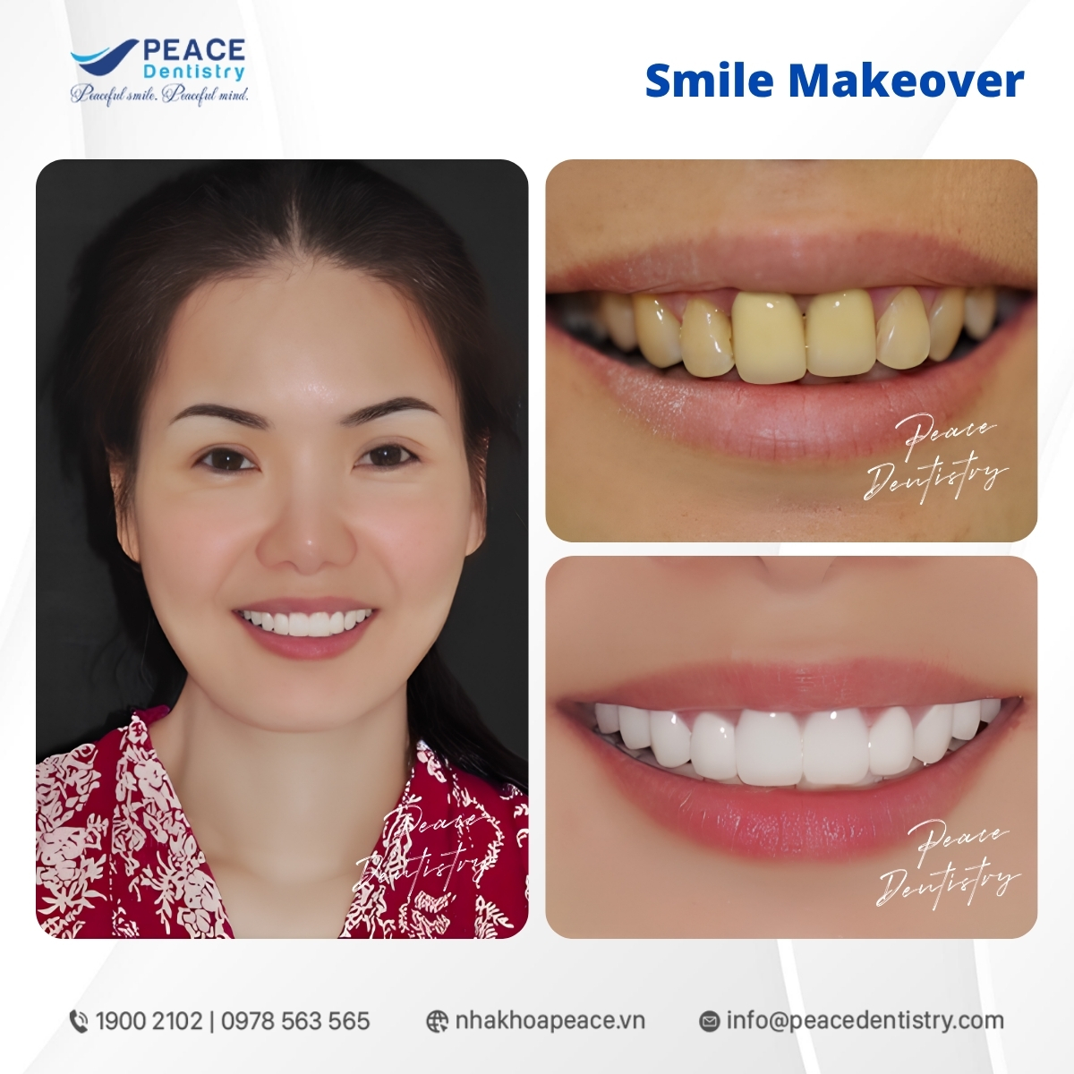 bọc răng sứ toàn hàm với sứ zirconia