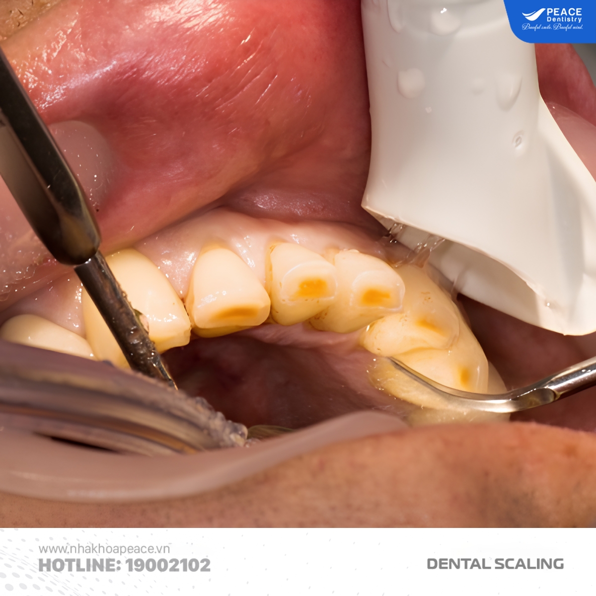 thiết bị cạo vôi răng