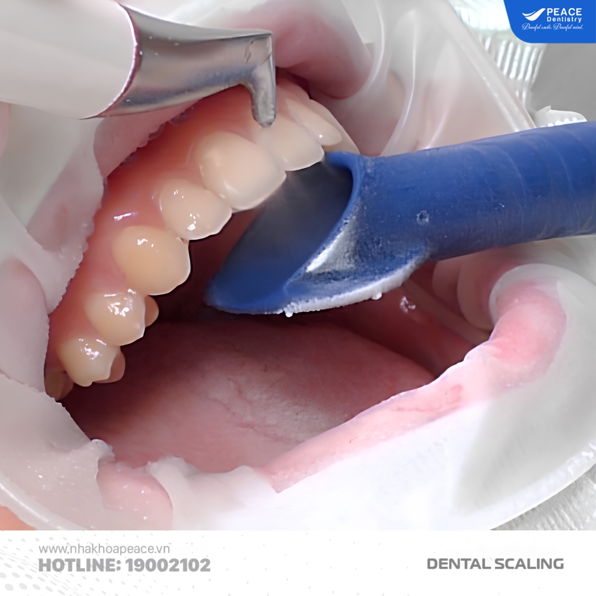 tia nước loại bỏ vôi răng
