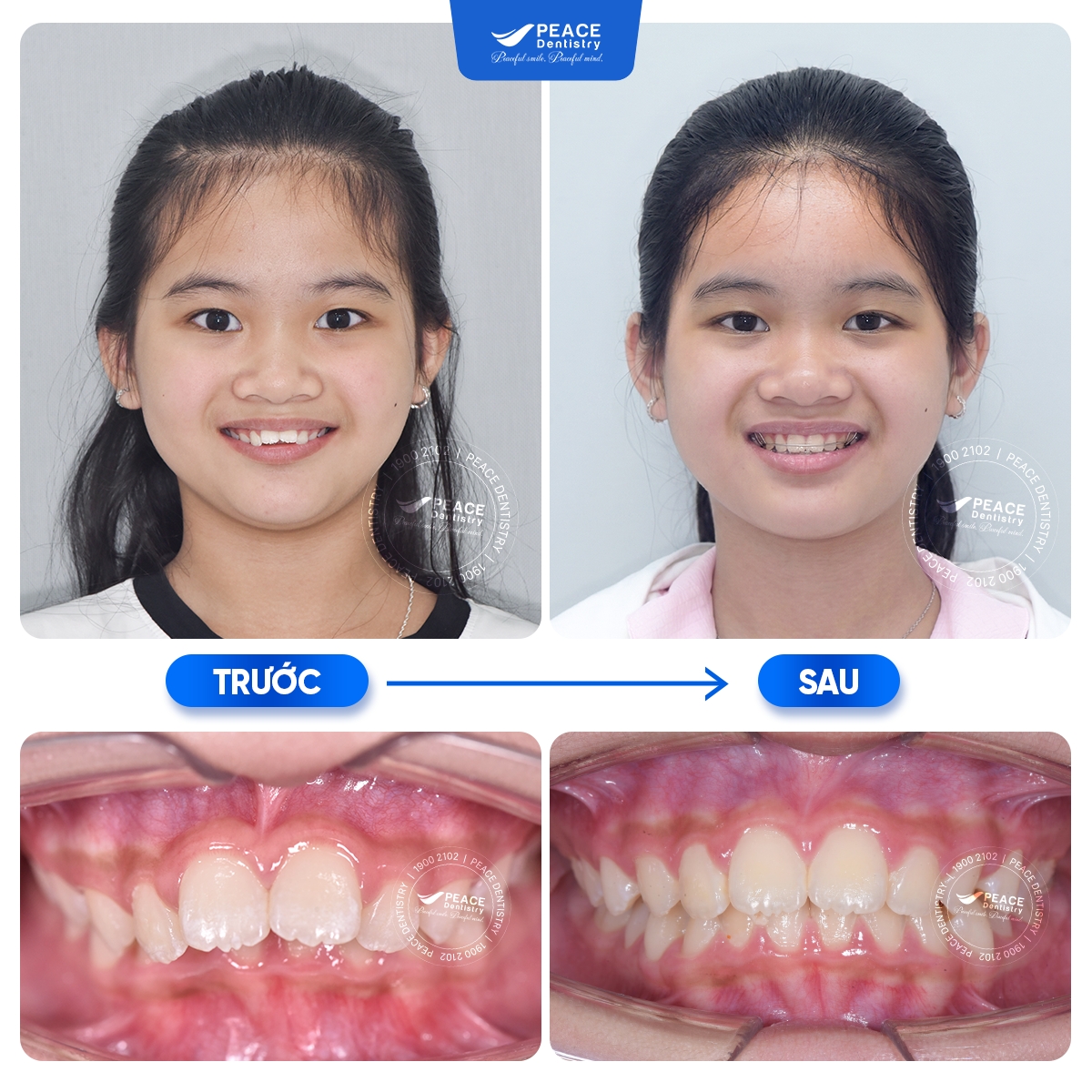 độ tuổi niềng răng