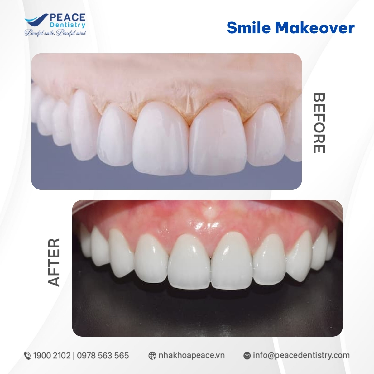răng sứ chế tác tinh tế