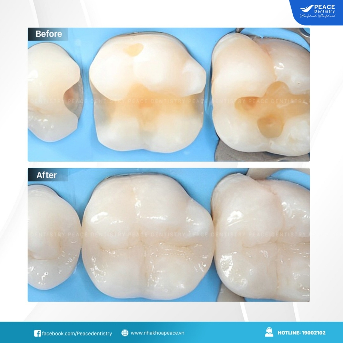 quy trình điều trị sâu răng