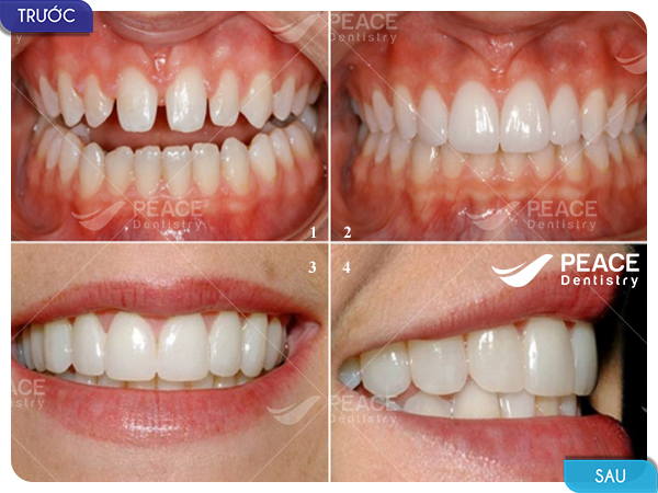 bọc răng sứ cho răng thưa hở kẽ