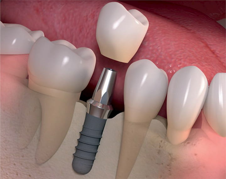 quy trình cấy ghép implant giai đoạn 2